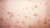 In rare chickenpox case, itchy blisters mushroom into large, rubbery nodules