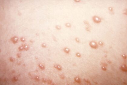 In rare chickenpox case, itchy blisters mushroom into large, rubbery nodules