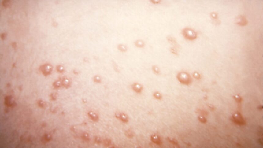 In rare chickenpox case, itchy blisters mushroom into large, rubbery nodules