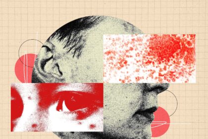 You Should Be More Freaked Out by Shingles