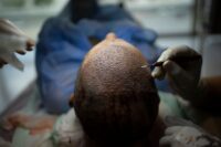 How Turkey Hacked the Hair Transplant Industry